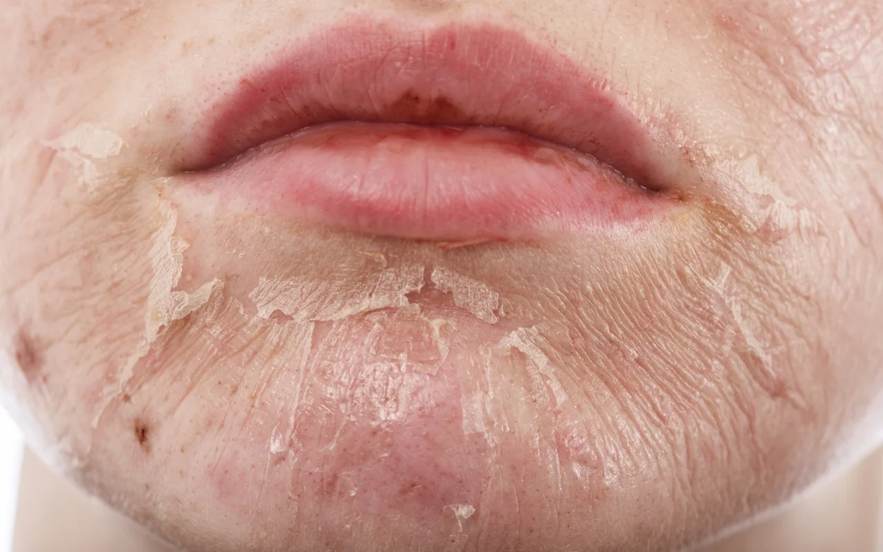Professionelle kosmetische Nachpflege nach einem Peeling