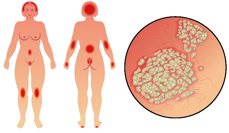Didaktische Illustration möglicher Hautbereiche mit Psoriasis-Plaques