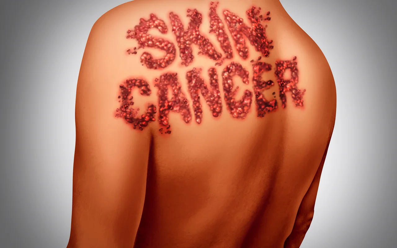 Illustration symbolique d’une alerte sur le risque de cancer cutané