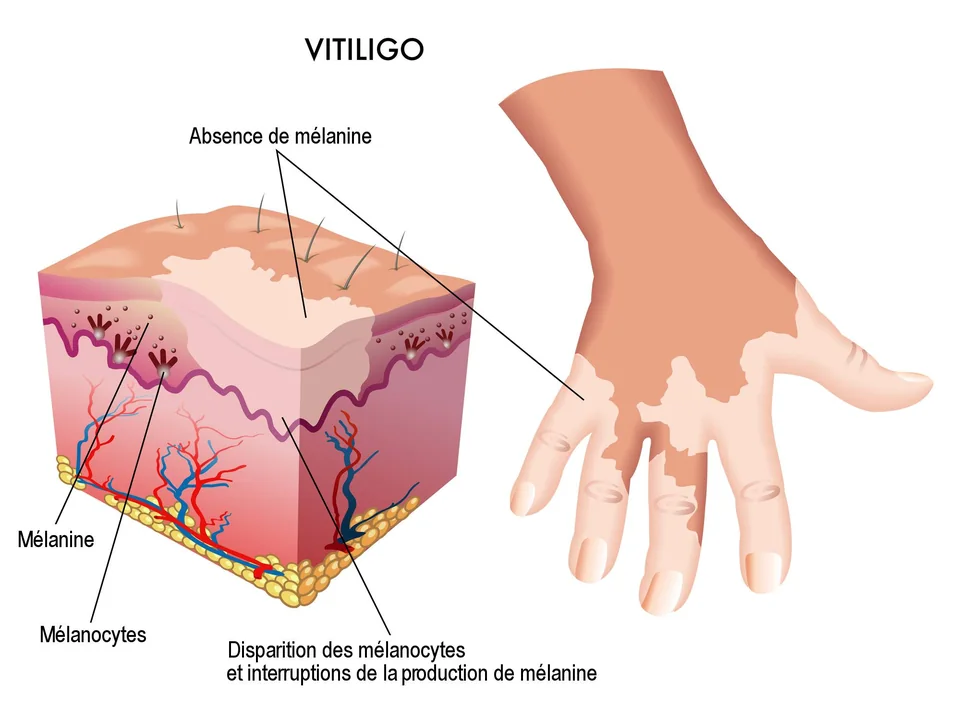 Schéma illustratif de la mélanine et des mélanocytes dans le vitiligo